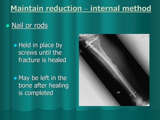 Maintain reduction – internal method
 Nail or rods
 Held in place by
screws until the
fracture is healed
 May be left in the
bone after healing
is completed
 
