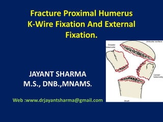 Fracture Proximal Humerus
K-Wire Fixation And External
Fixation.
JAYANT SHARMA
M.S., DNB.,MNAMS.
Web :www.drjayantsharma@gmail.com
 