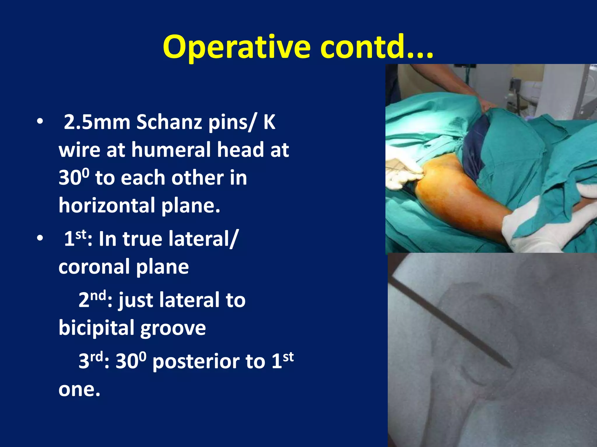 Operative contd...
• 2.5mm Schanz pins/ K
wire at humeral head at
300 to each other in
horizontal plane.
• 1st: In true lateral/
coronal plane
2nd: just lateral to
bicipital groove
3rd: 300 posterior to 1st
one.
 