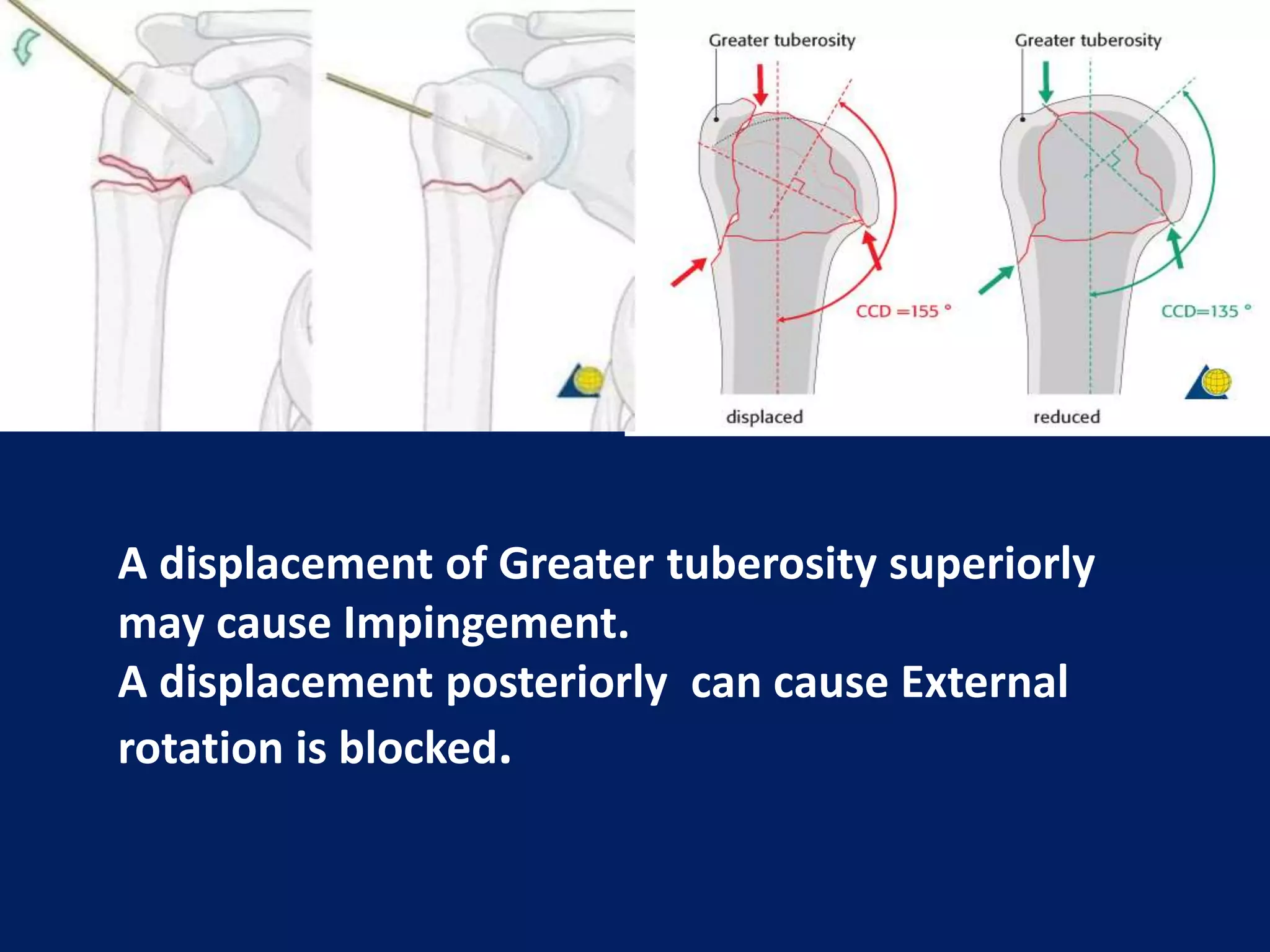 A displacement of Greater tuberosity superiorly
may cause Impingement.
A displacement posteriorly can cause External
rotation is blocked.
 