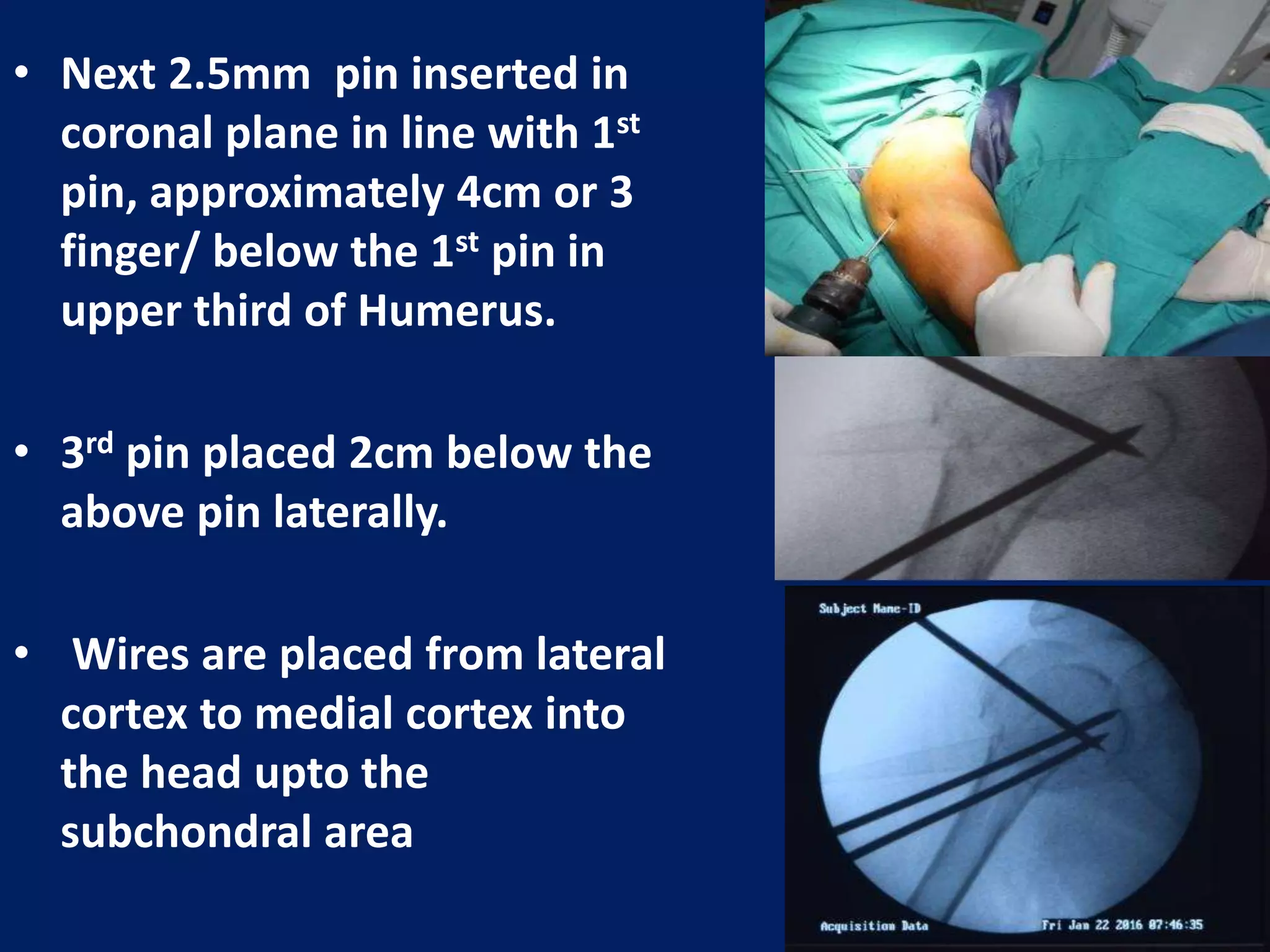 • Next 2.5mm pin inserted in
coronal plane in line with 1st
pin, approximately 4cm or 3
finger/ below the 1st pin in
upper third of Humerus.
• 3rd pin placed 2cm below the
above pin laterally.
• Wires are placed from lateral
cortex to medial cortex into
the head upto the
subchondral area
 
