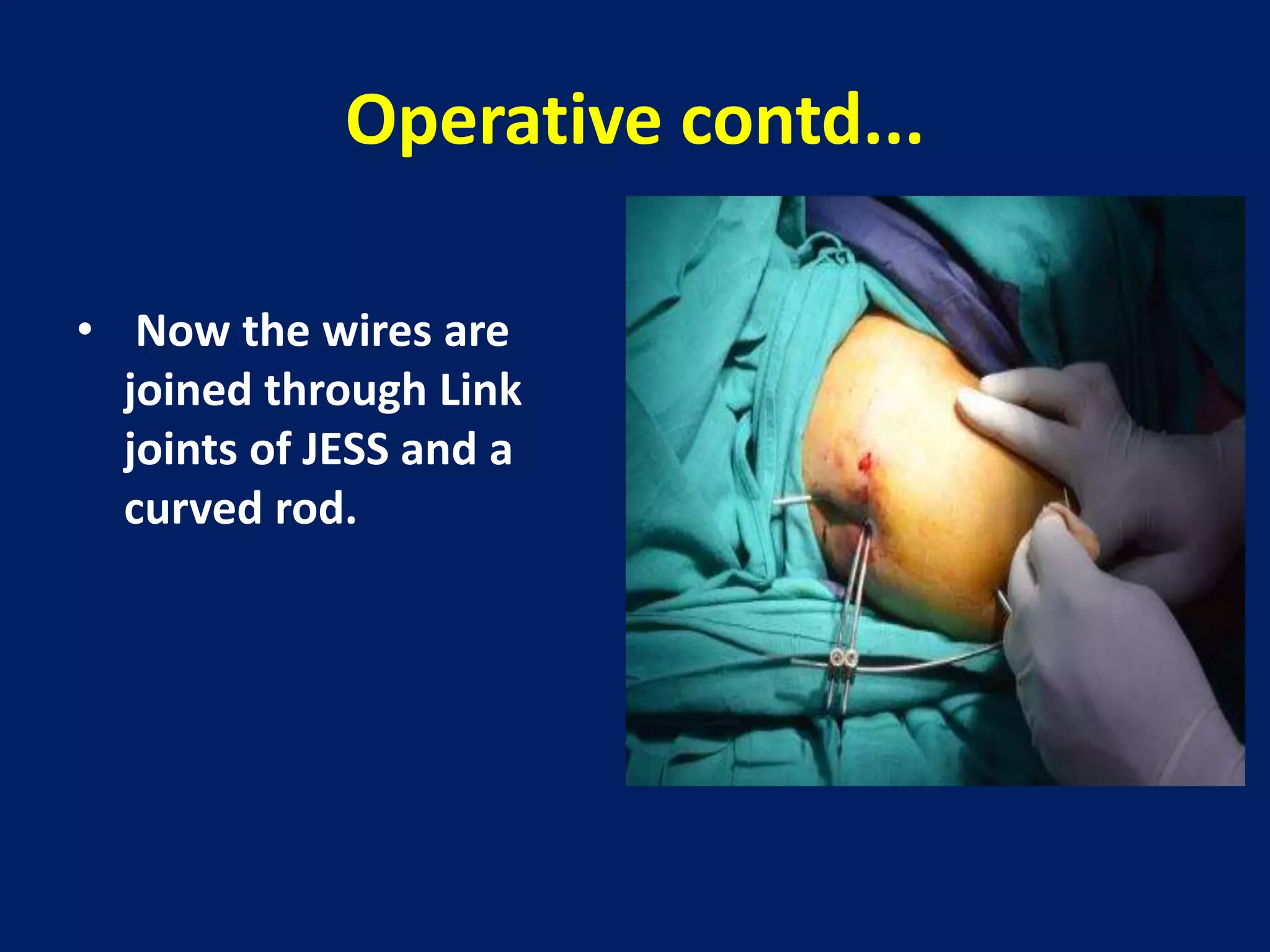 Operative contd...
• Now the wires are
joined through Link
joints of JESS and a
curved rod.
 