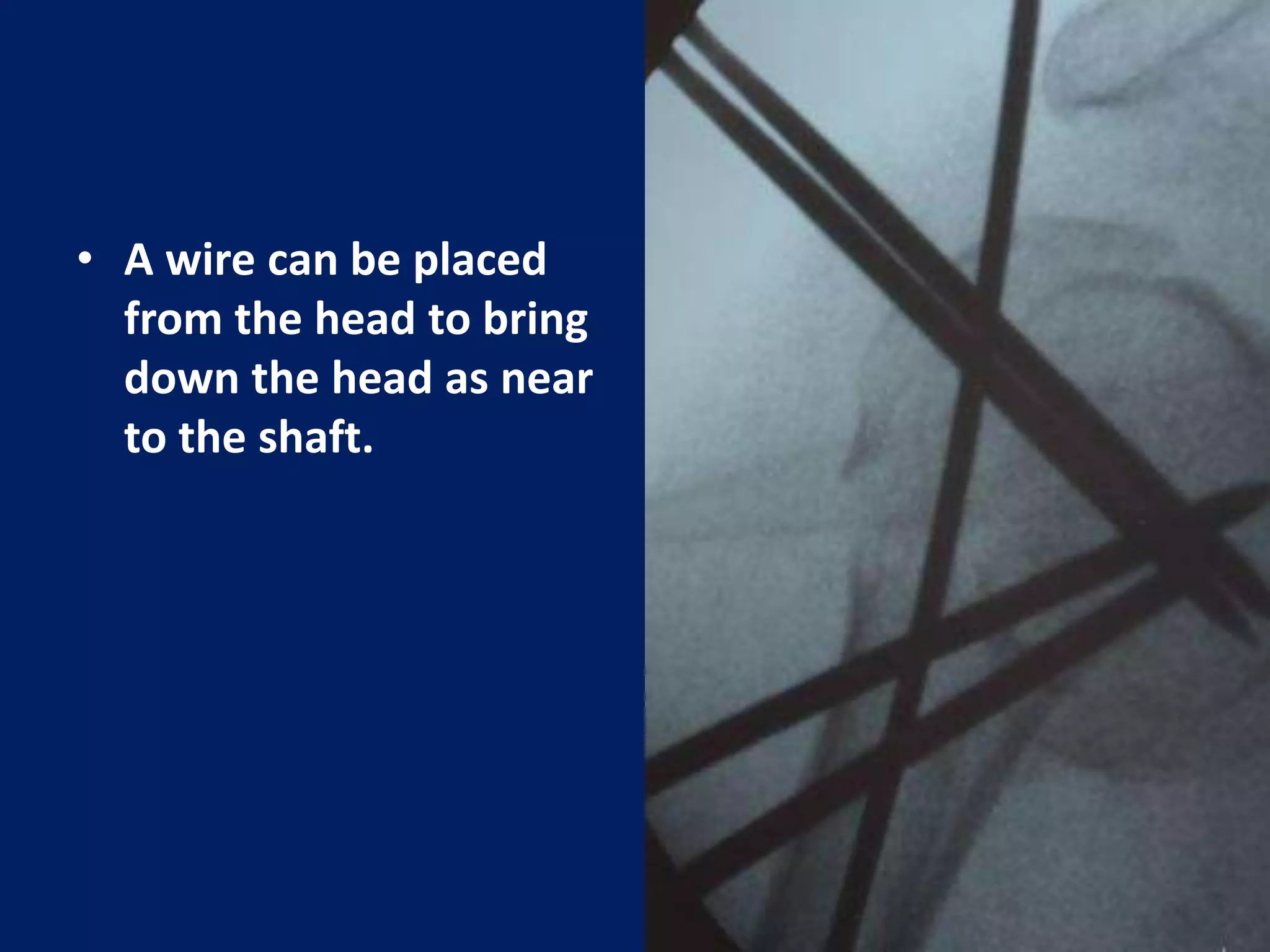 • A wire can be placed
from the head to bring
down the head as near
to the shaft.
 