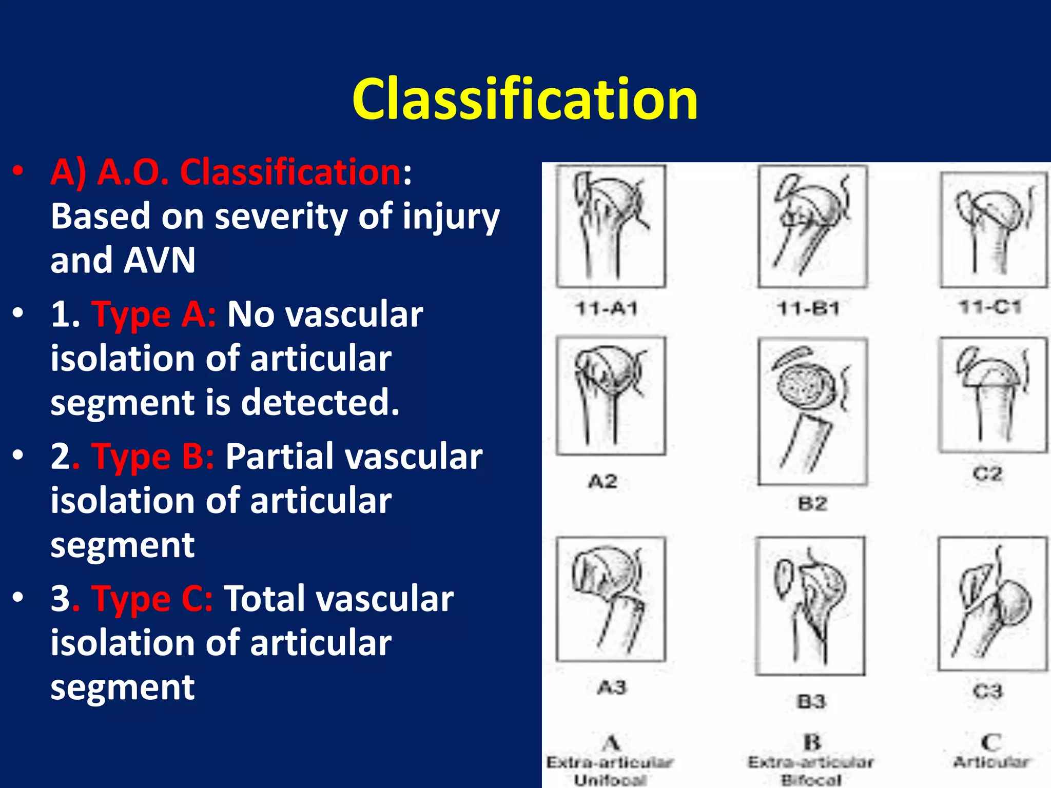 Classification
• A) A.O. Classification:
Based on severity of injury
and AVN
• 1. Type A: No vascular
isolation of articular
segment is detected.
• 2. Type B: Partial vascular
isolation of articular
segment
• 3. Type C: Total vascular
isolation of articular
segment
 