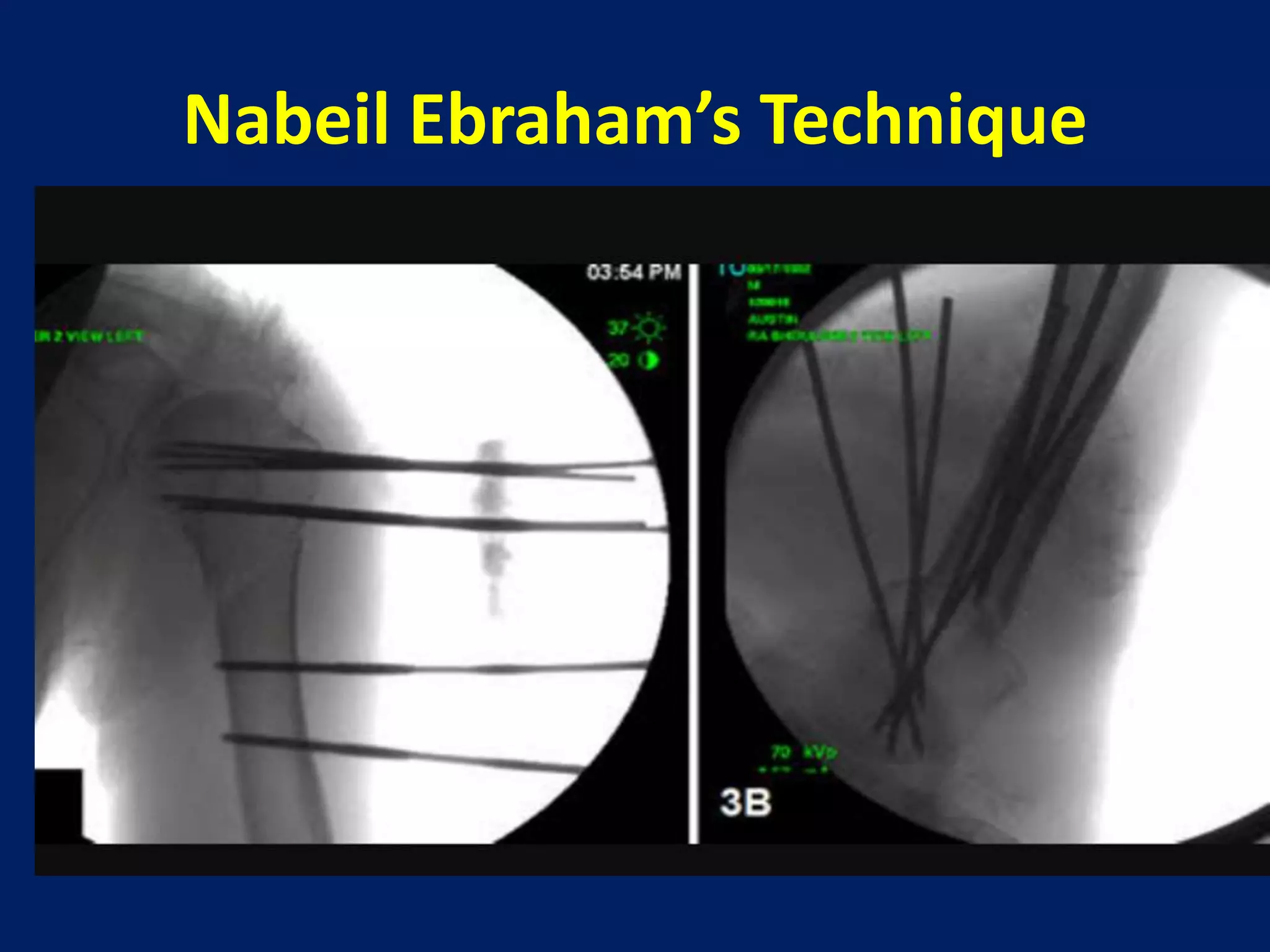 Nabeil Ebraham’s Technique
 