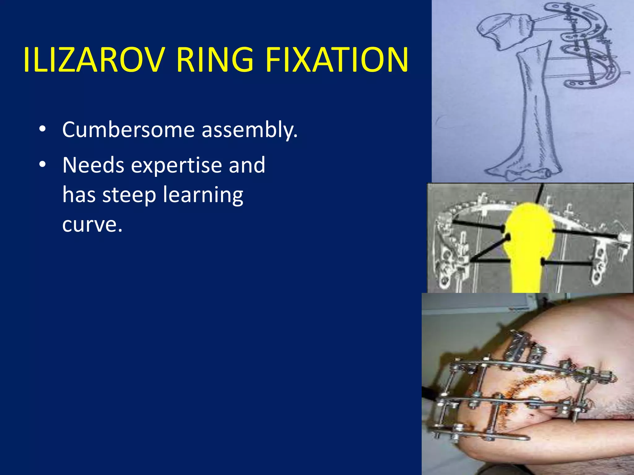 ILIZAROV RING FIXATION
• Cumbersome assembly.
• Needs expertise and
has steep learning
curve.
 