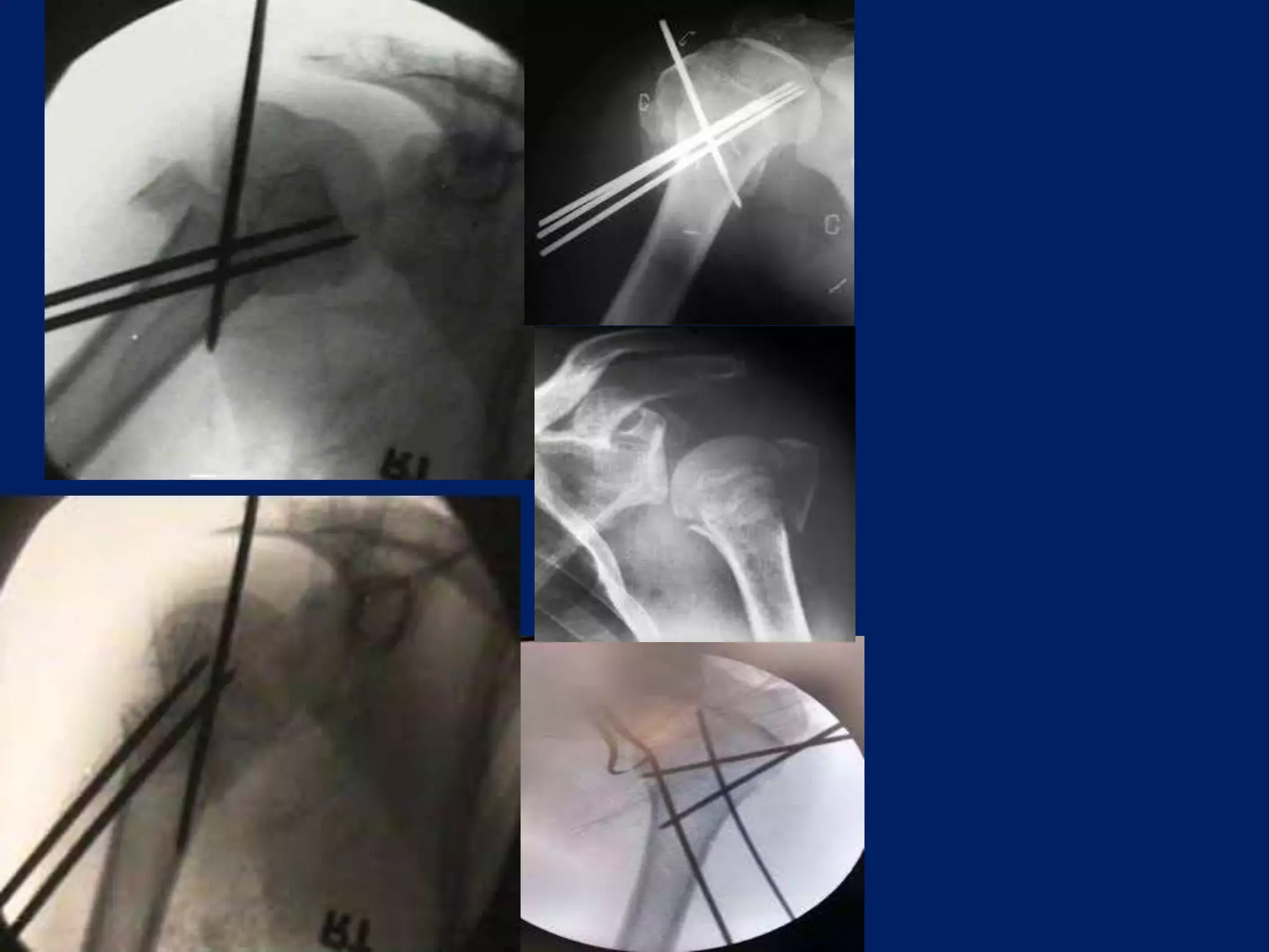 Fracture proximal humerus Fixation with K wires and External fixator