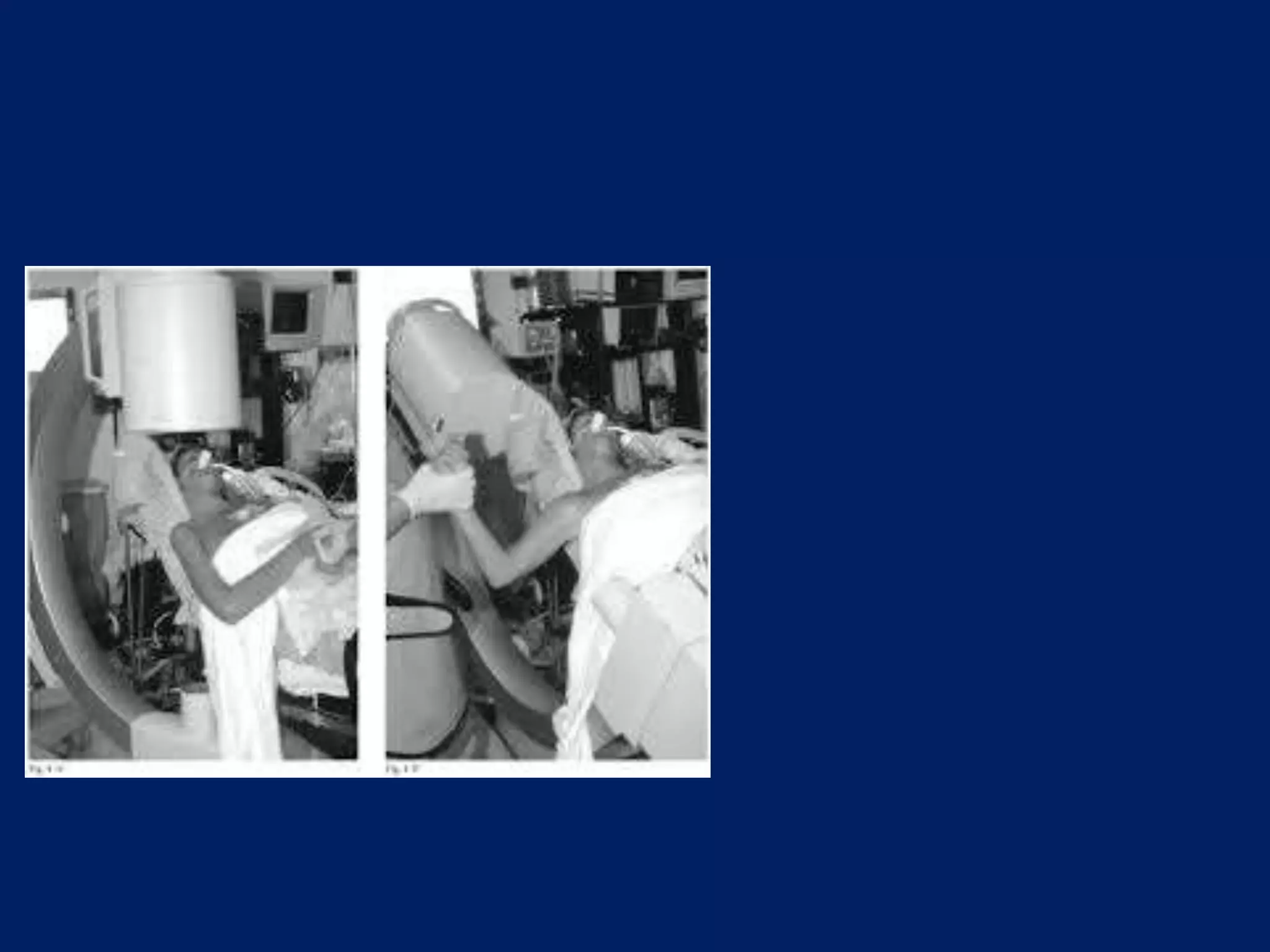 Fracture proximal humerus Fixation with K wires and External fixator