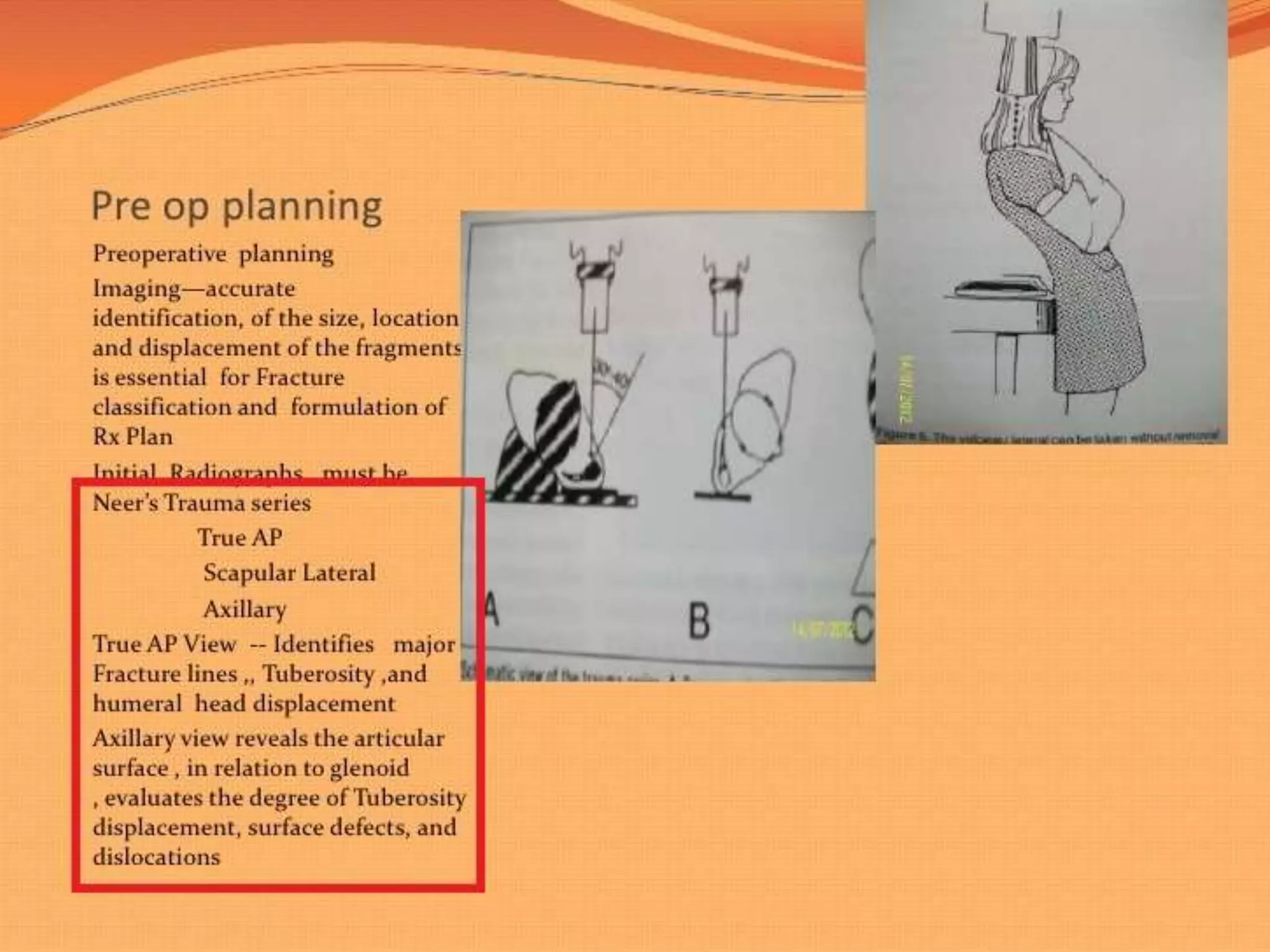 Fracture proximal humerus Fixation with K wires and External fixator