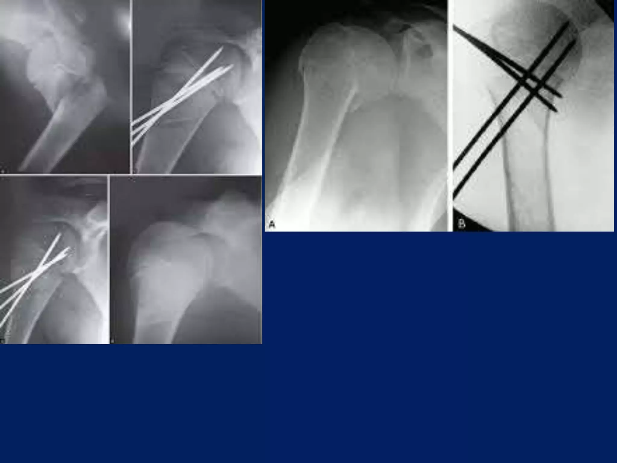 Fracture proximal humerus Fixation with K wires and External fixator
