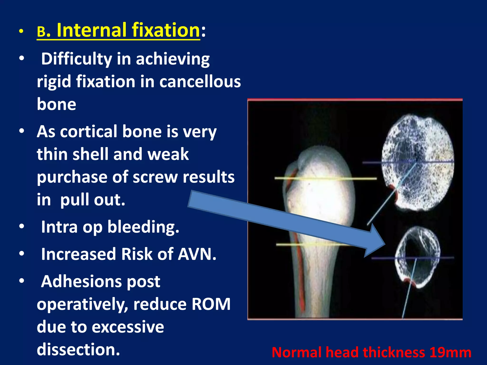 • B. Internal fixation:
• Difficulty in achieving
rigid fixation in cancellous
bone
• As cortical bone is very
thin shell and weak
purchase of screw results
in pull out.
• Intra op bleeding.
• Increased Risk of AVN.
• Adhesions post
operatively, reduce ROM
due to excessive
dissection. Normal head thickness 19mm
 