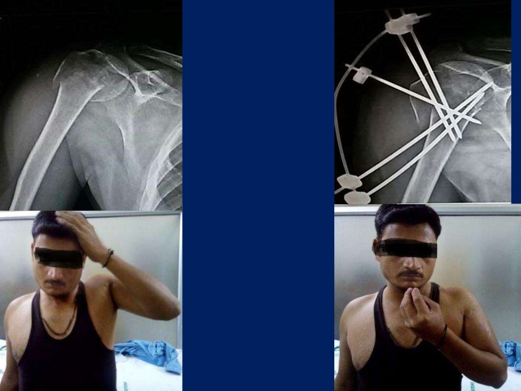 Fracture proximal humerus Fixation with K wires and External fixator