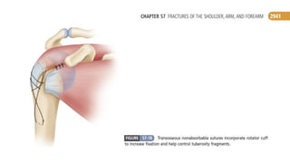 Fracture proximal humerus | PPTX