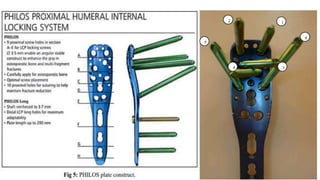 Fracture proximal humerus | PPTX