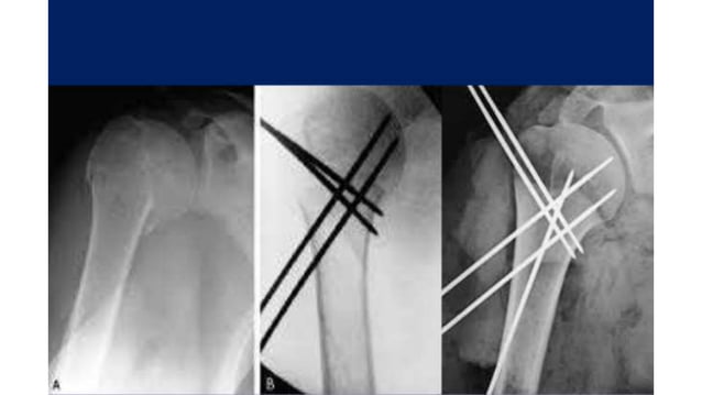Fracture proximal humerus | PPTX