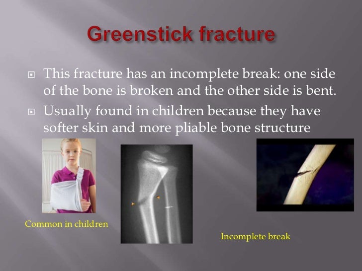 bone fracture vs break bone fracture vs break