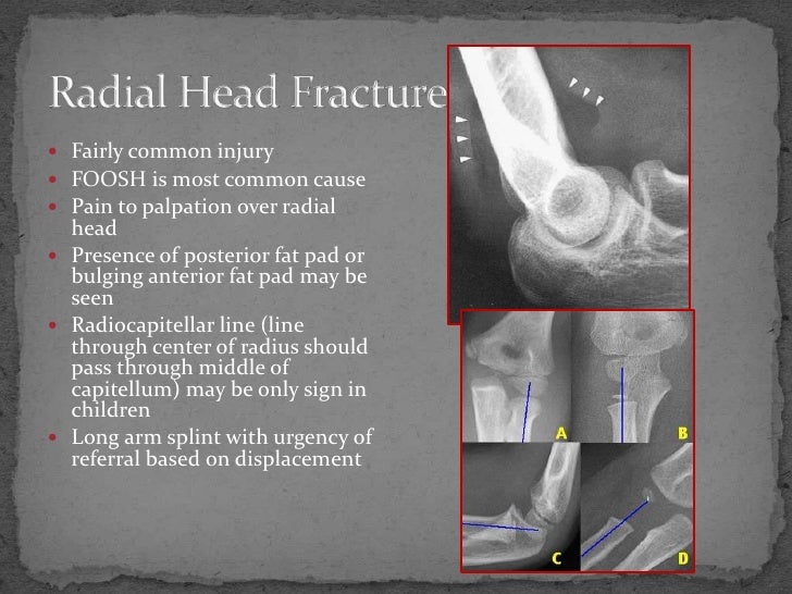 Fracture Review New Format