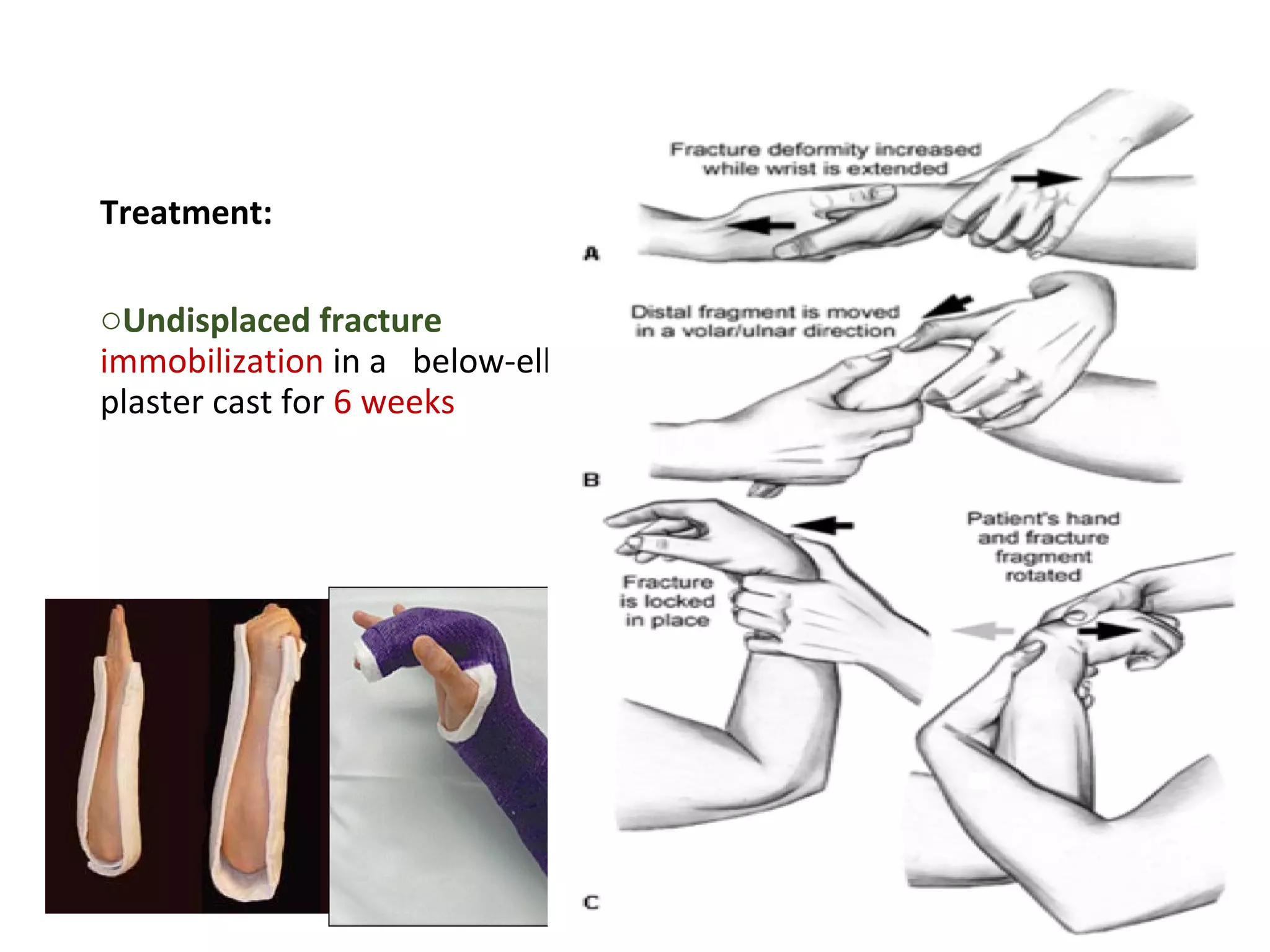 Treatment:
oUndisplaced fracture
immobilization in a below-elbow
plaster cast for 6 weeks
oDisplaced fracture manipulative
reduction followed by immobilization
in Colles’ cast
 