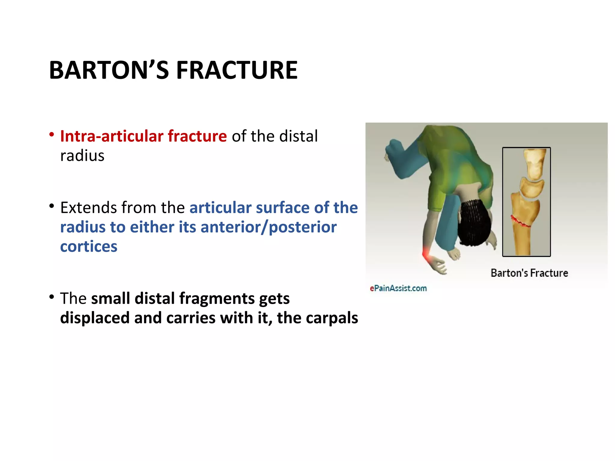 BARTON’S FRACTURE
• Intra-articular fracture of the distal
radius
• Extends from the articular surface of the
radius to either its anterior/posterior
cortices
• The small distal fragments gets
displaced and carries with it, the carpals
 