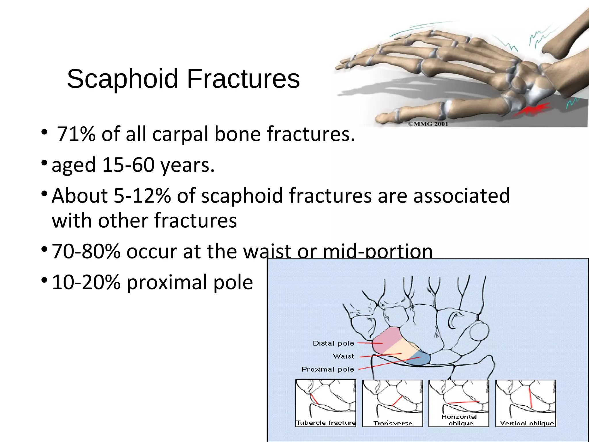 Scaphoid Fractures
• 71% of all carpal bone fractures.
•aged 15-60 years.
•About 5-12% of scaphoid fractures are associated
with other fractures
•70-80% occur at the waist or mid-portion
•10-20% proximal pole
 
