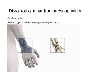 Distal radial ulnar fracture/scaphoid #
Dr abdul rub
Attending consultant emergency department
 