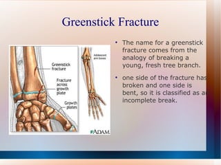Greenstick Fracture The name for a greenstick fracture comes from the analogy of breaking a young, fresh tree branch. one side of the fracture has broken and one side is bent, so it is classified as an incomplete break. 