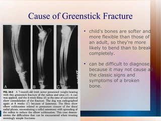 Cause of Greenstick Fracture child's bones are softer and more flexible than those of an adult, so they're more likely to bend than to break completely. can be difficult to diagnose, because it may not cause all the classic signs and symptoms of a broken bone. 