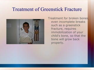 Treatment of Greenstick Fracture Treatment for broken bones, even incomplete breaks such as a greenstick fracture, requires immobilization of your child's bone, so that the bone will grow back properly. 