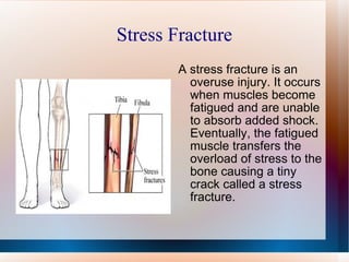 Stress Fracture A stress fracture is an overuse injury. It occurs when muscles become fatigued and are unable to absorb added shock. Eventually, the fatigued muscle transfers the overload of stress to the bone causing a tiny crack called a stress fracture. 
