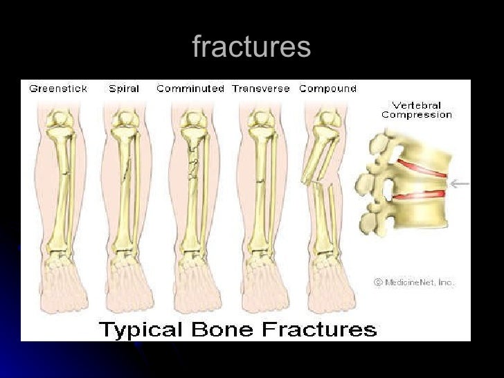 Fractures