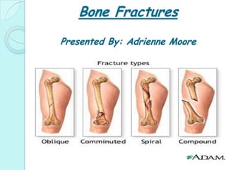 Bone FracturesPresented By: Adrienne Moore 