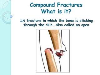 Types of FracturesGreenstick Fractures