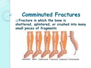   Because a child's bones are much more    pliable than adult bone, an incomplete, or 'greenstick,' fracture may occur. A "greenstick fracture" means that one side of the fracture has broken and one side is bent; therefore it is classified as an incomplete break.Greenstick FractureThe name for a greenstick fracture comes from the analogy of breaking a young, fresh tree branch. The broken branch snaps on one side (the outer side of the bend), while the inner side is bent, and still in continuity. Most often the greenstick fracture must be bent back into the proper position (called a "reduction") and then casted for about six weeks. Greenstick fractures can take a long time to heal because they tend to occur in the middle, slower growing parts of bone.