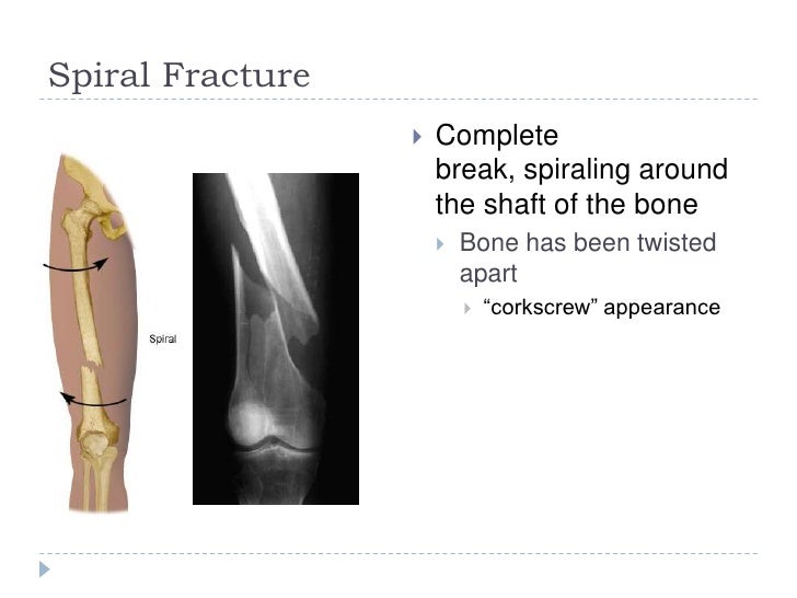 Fractures greenstick, transverse & spiral