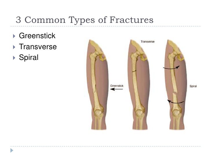 Fractures greenstick, transverse & spiral