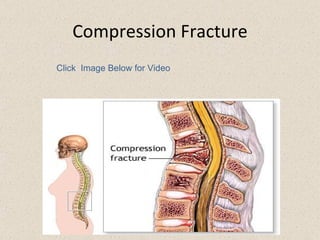 Fractures | PPT