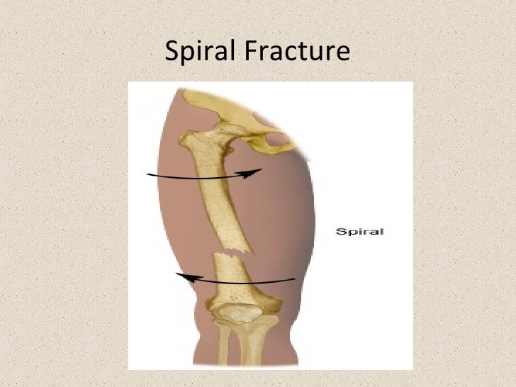 spiral fracture recovery time spiral fracture recovery time