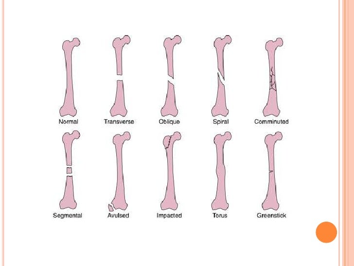 fracture definition