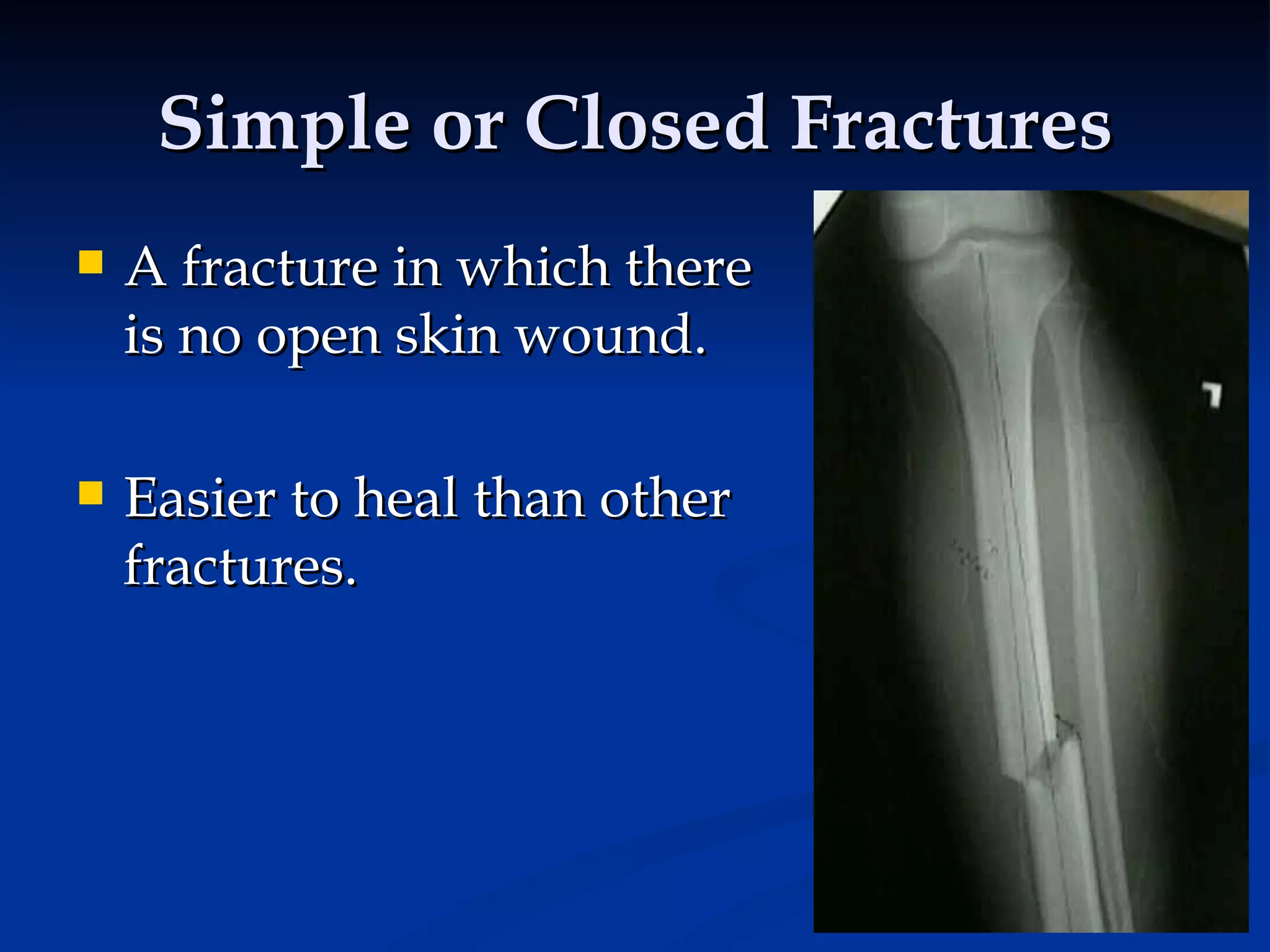 Simple or Closed Fractures A fracture in which there is no open skin wound.  Easier to heal than other fractures. 
