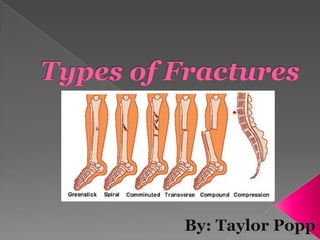Types of Fractures By: Taylor Popp 