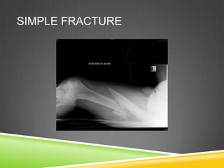Math Simple Fracture Fractures | PPTX