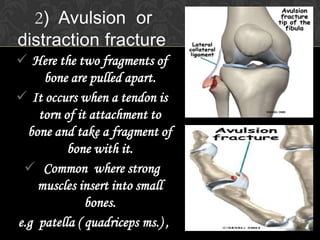 Fractures | PPTX