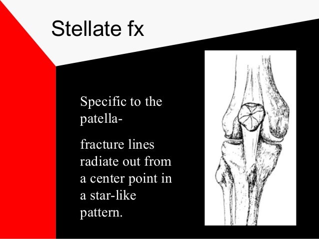 Fractures
