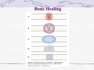 Bone Healing
 
