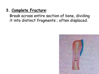 Fractures | PPTX