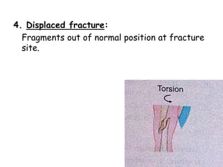 4. Displaced fracture:
Fragments out of normal position at fracture
site.
 
