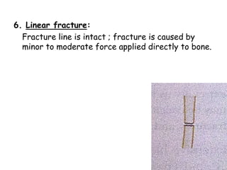 6. Linear fracture:
Fracture line is intact ; fracture is caused by
minor to moderate force applied directly to bone.
 