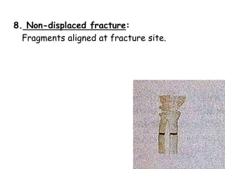 8. Non-displaced fracture:
Fragments aligned at fracture site.
 
