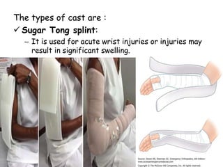 The types of cast are :
 Sugar Tong splint:
– It is used for acute wrist injuries or injuries may
result in significant swelling.
 