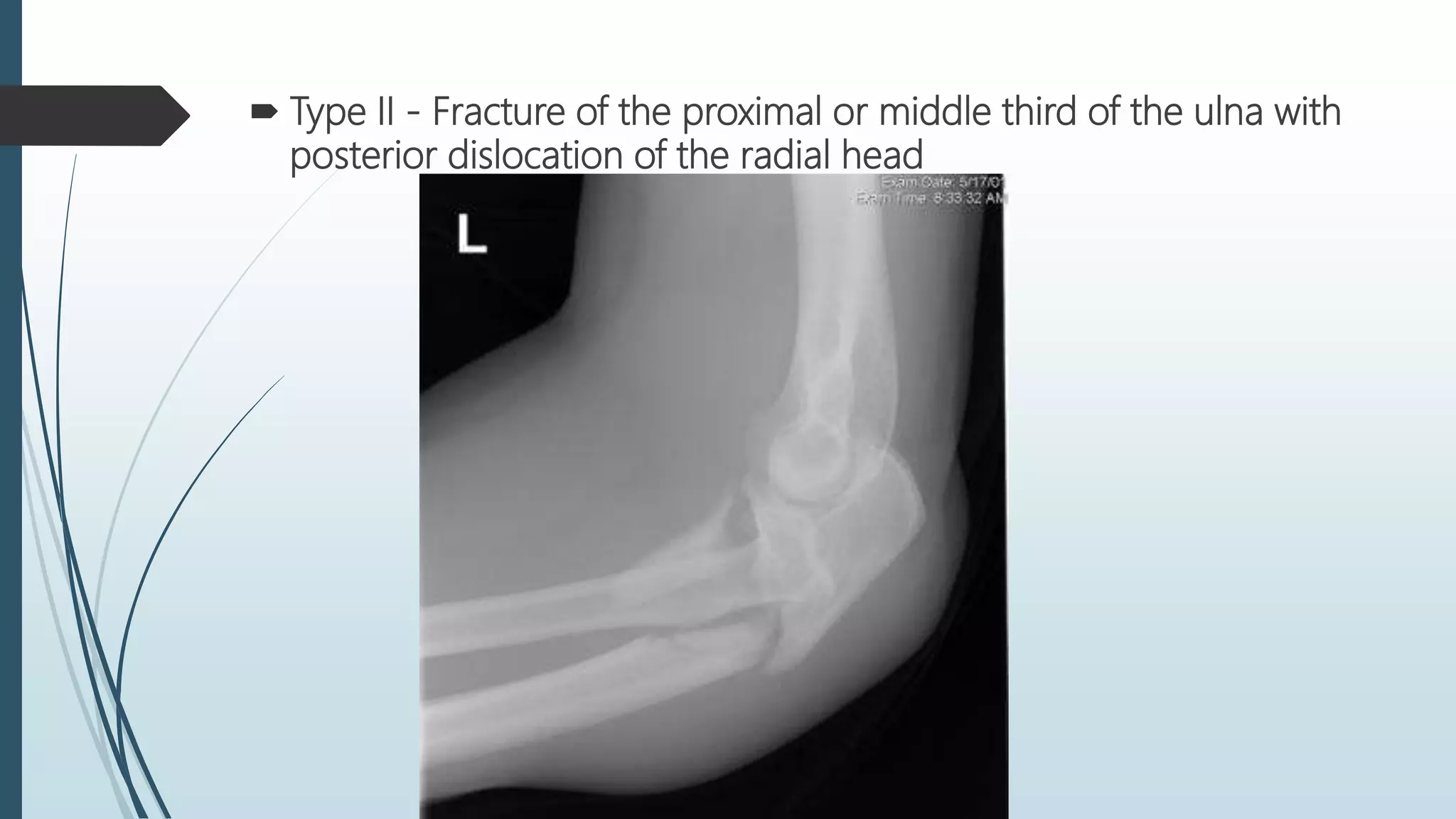 Fractures of radius and ulna . | PPTX